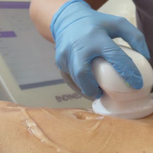Radiofrecuencia RF convencional/ Pack 10 sesiones(abdomen, glúteos, muslos solo 1 cara)